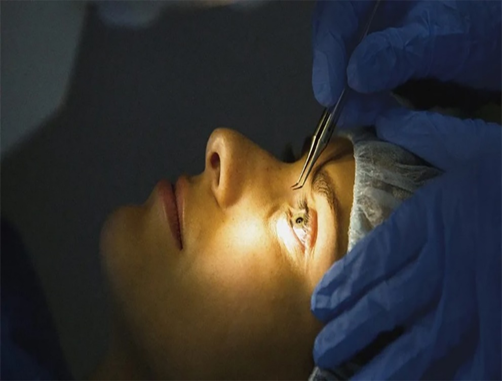 Eye laser treatment is introduced.